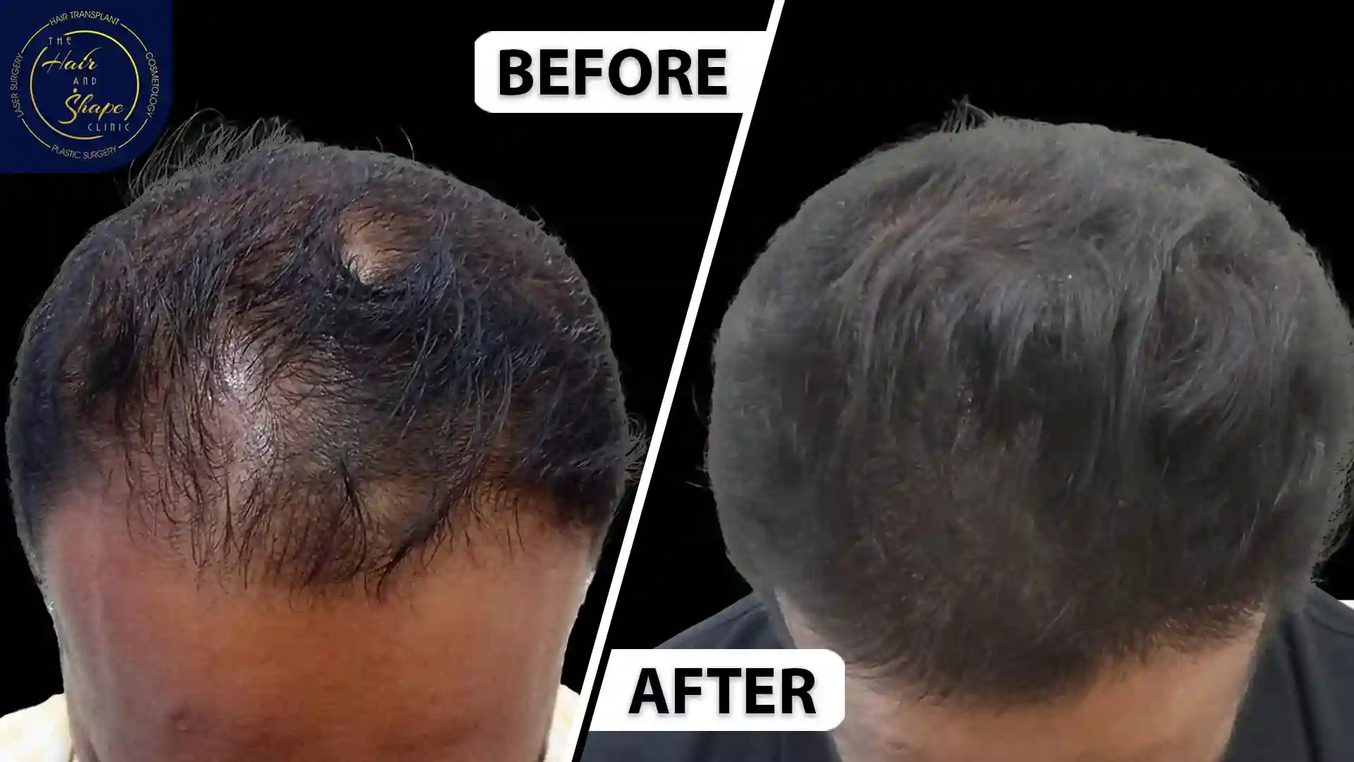 PRP Treatment result4